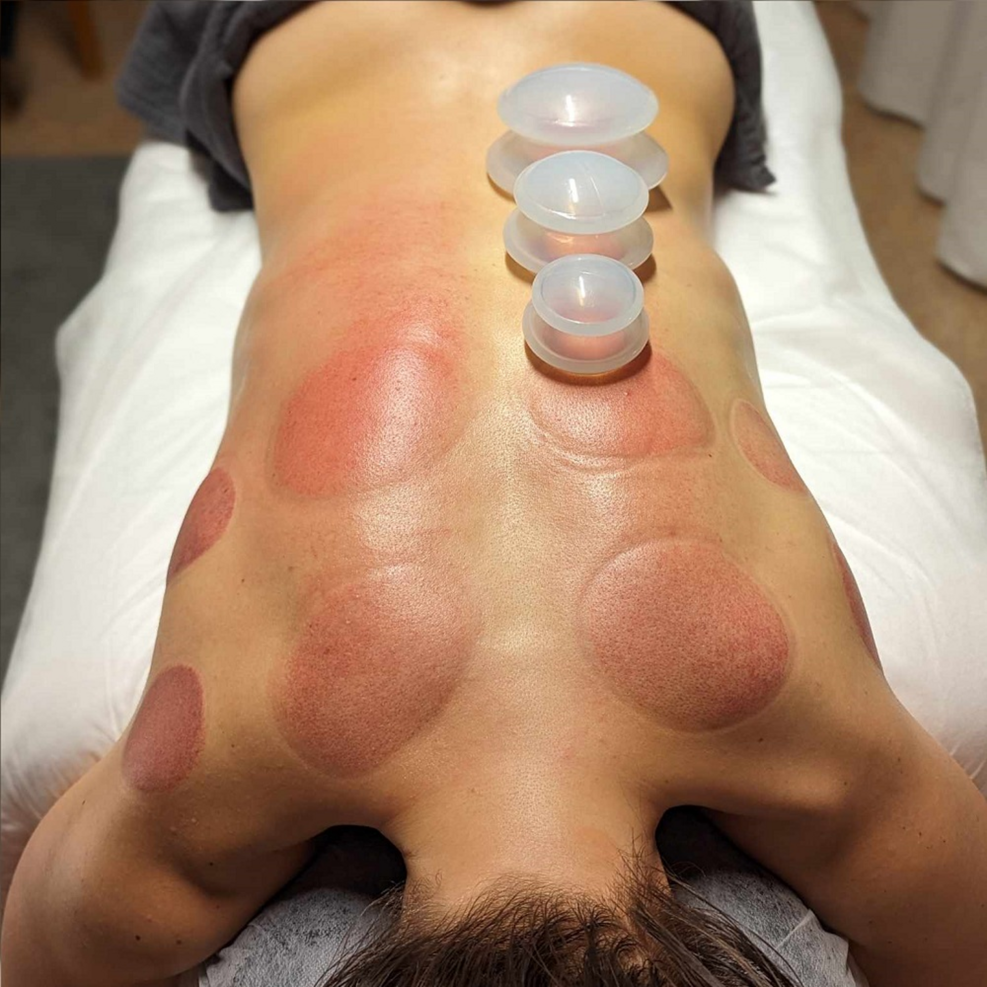 TRENDREHAB, Cuppingset &ndash; Effective And Relaxing